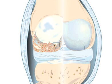 Ostenil-Gelenkregeneration