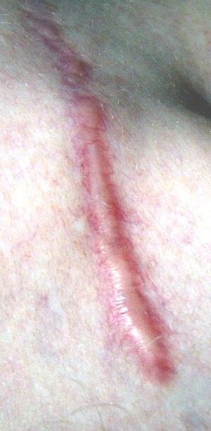 Scar before NTH